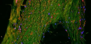 Подробнее о статье Нові відкриття в дослідженні хвороби Альцгеймера